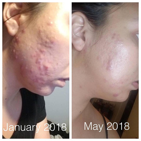 Super Acne Fighter / Organische Acne Behandeling / Acne