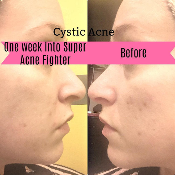 Super Acne Fighter / Organische Acne Behandeling / Acne