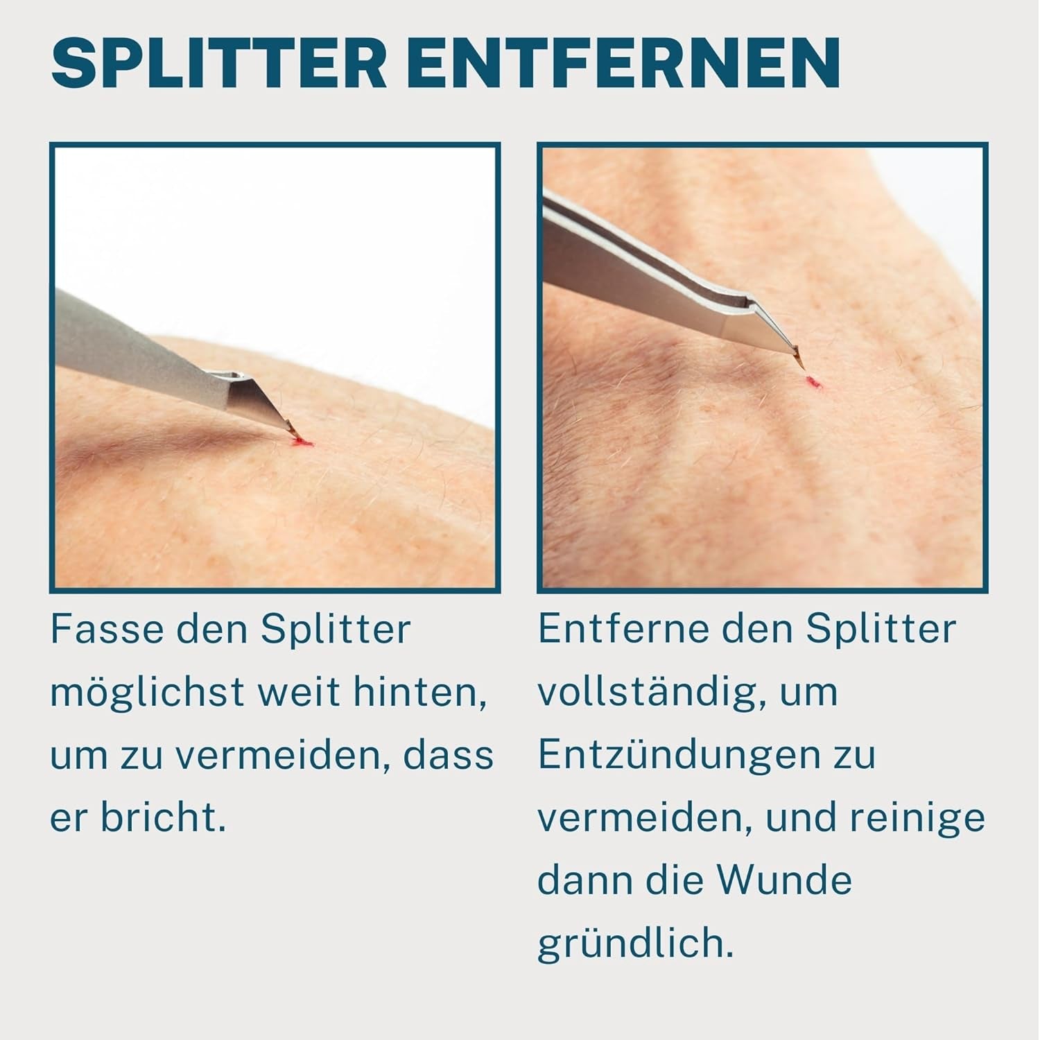 REMOS Kombipinzette Edelstahl [Inox]Rostfrei 9.5 Cm - 2In1 Für Splitter - Haare